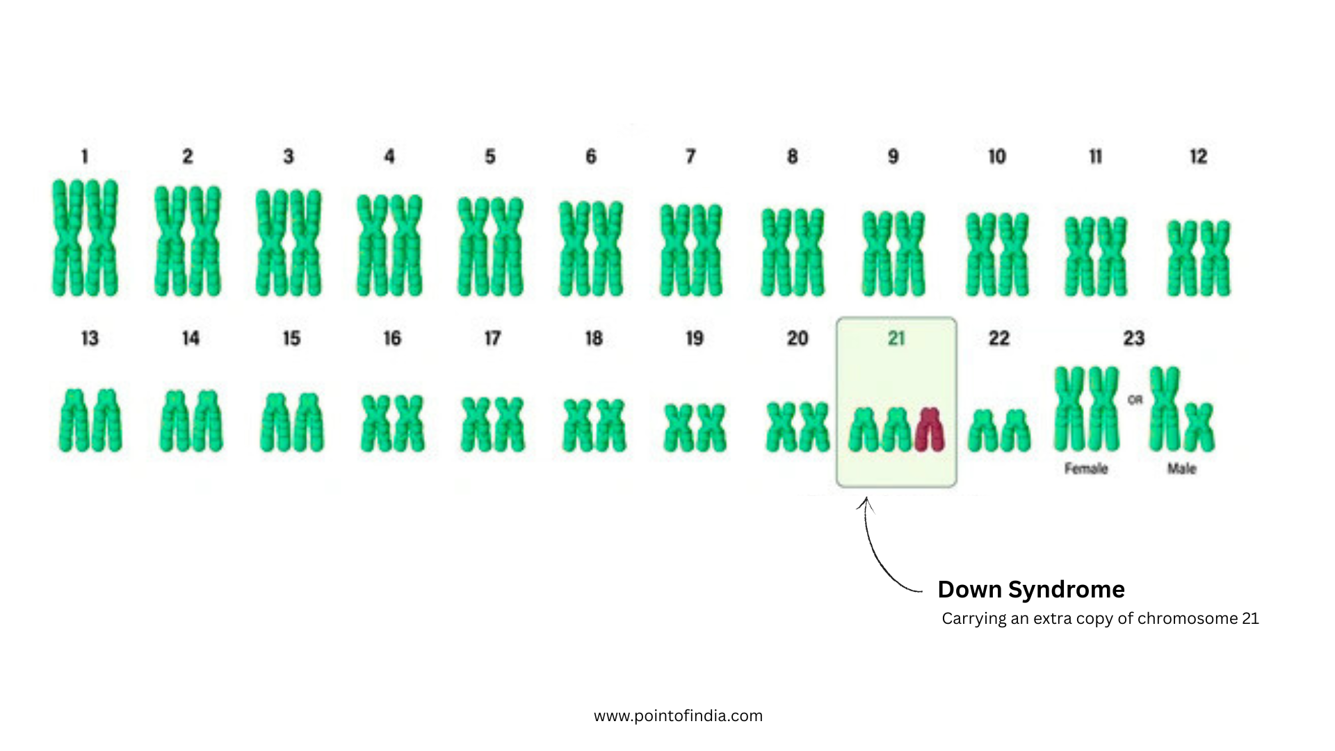 Illustration Showing Extra Copy of Chromosome 21 in Down Syndrome